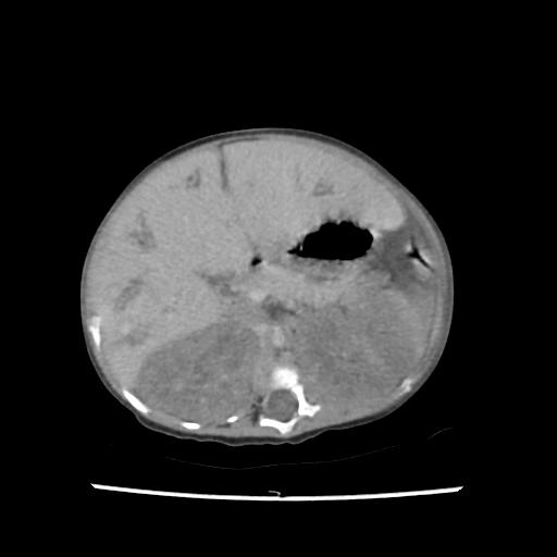 Caroli disease with autosomal recessive polycystic kidney disease (ARPKD) (Radiopaedia 89651-106703 B 79).jpg
