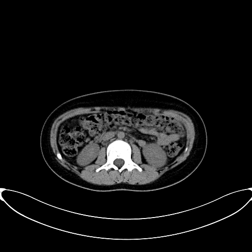 Caroli disease with medullary sponge kidney (Radiopaedia 82622-96804 Axial non-contrast 33).jpg