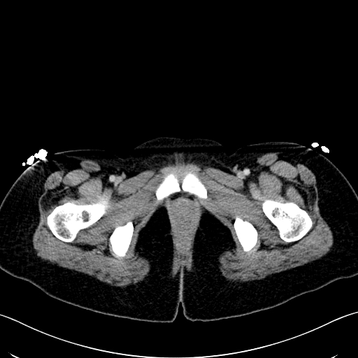 Caroli disease with medullary sponge kidney (Radiopaedia 82622-96804 C 79).jpg