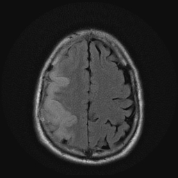 File:Carotid arterial dissection with acute cerebral infarction (Radiopaedia 26636-26784 Axial FLAIR 17).jpg