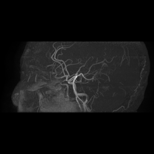 Carotid arterial dissection with acute cerebral infarction (Radiopaedia 26636-26784 MRA 5).jpg
