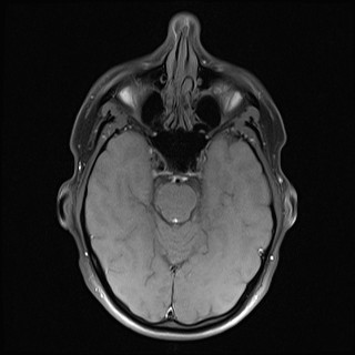 File:Carotid artery dissection (Radiopaedia 28441-28689 Axial T1 fat sat 39).jpg