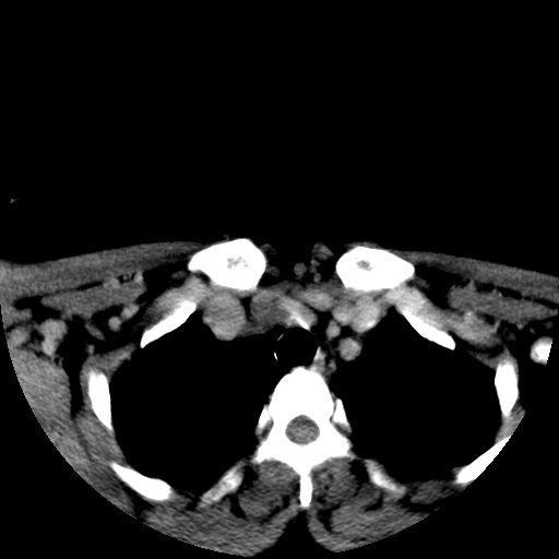 File:Carotid body tumor (Radiopaedia 27890-28124 A 32).jpg