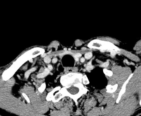 Carotid body tumor (Radiopaedia 61750-69757 Axial Post contrast 109).jpg
