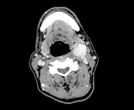 Carotid body tumor (Radiopaedia 61750-69757 Axial Post contrast 48).jpg