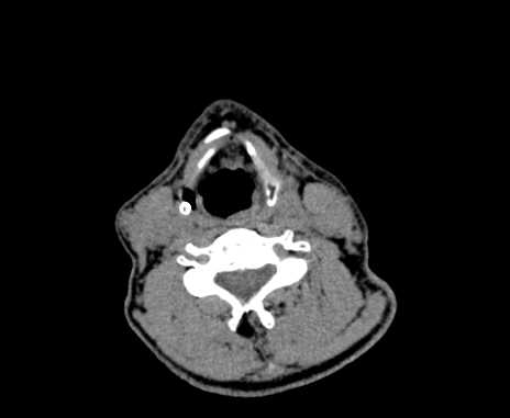Carotid body tumor (Radiopaedia 61750-69757 Axial non-contrast 65).jpg