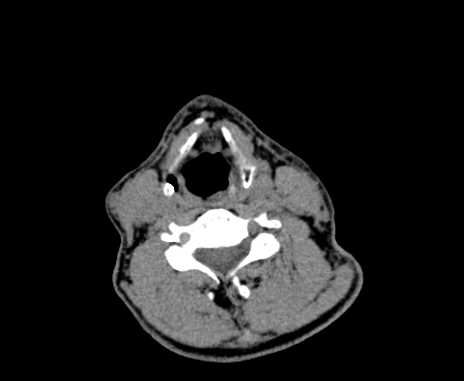 Carotid body tumor (Radiopaedia 61750-69757 Axial non-contrast 66).jpg