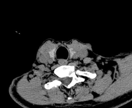 Carotid body tumor (Radiopaedia 61750-69757 Axial non-contrast 95).jpg