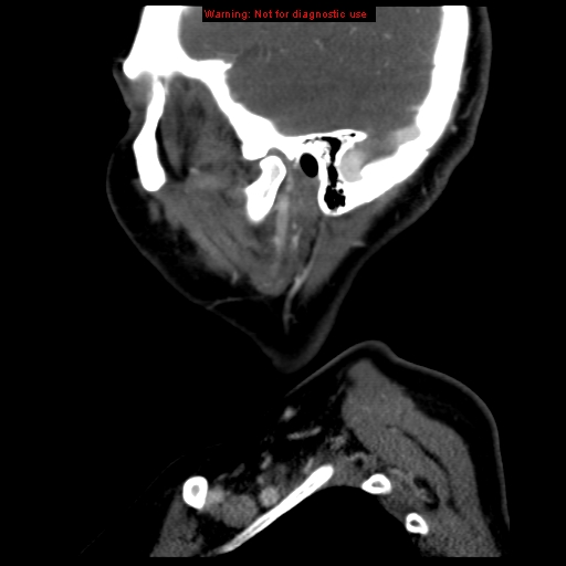 Carotid body tumor with lung metastases (Radiopaedia 9301-9986 Sagittal C+ delayed 6).jpg