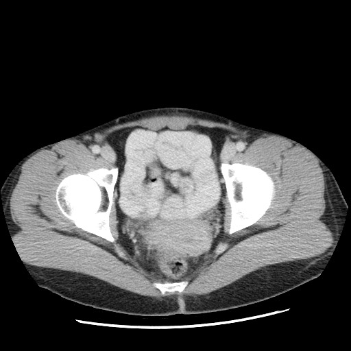 Castleman disease with fibrous pseudotumor in the abdomen (Radiopaedia 77296-89373 A 117).jpg