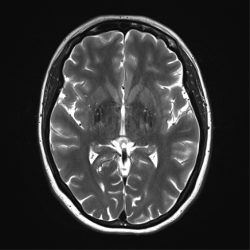 File:Cavernoma with bleed - midbrain (Radiopaedia 54546-60773 Axial T2 19).png