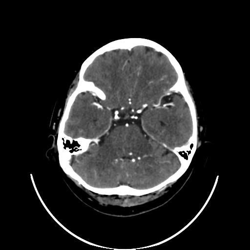 File:Cavernoma with developmental venous anomaly (Radiopaedia 22470-22506 C+ arterial phase 11).jpg