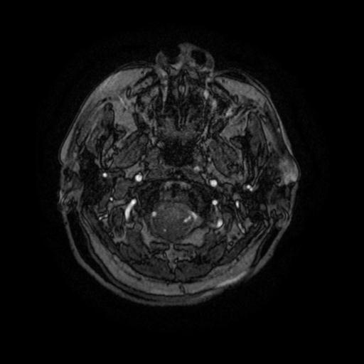 Cavernoma with developmental venous anomaly (Radiopaedia 22470-22507 MRA 107).jpg