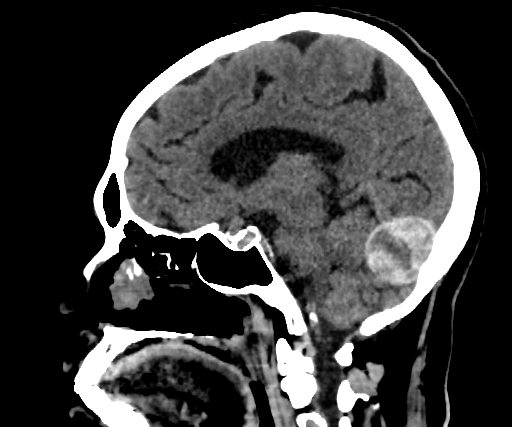 Cavernous hemangioma of the cerebellar falx (Radiopaedia 73025-83723 B 181).jpg