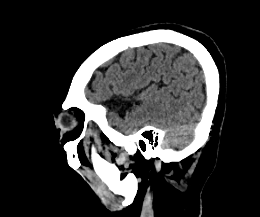 Cavernous hemangioma of the cerebellar falx (Radiopaedia 73025-83723 B 264).jpg