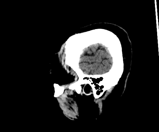 Cavernous hemangioma of the cerebellar falx (Radiopaedia 73025-83723 B 36).jpg