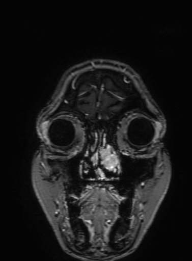 Cavernous hemangioma of the cerebellar falx (Radiopaedia 73025-83724 Coronal T1 C+ 36).jpg