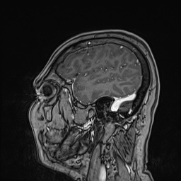 Cavernous sinus meningioma (Radiopaedia 63682-72367 Sagittal T1 C+ 46).jpg