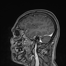 Cavernous sinus meningioma (Radiopaedia 63682-72367 Sagittal T1 C+ 54).jpg