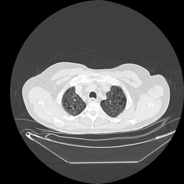 Cavitating bronchogenic carcinoma (Radiopaedia 44489-48162 Axial lung window 9).jpg