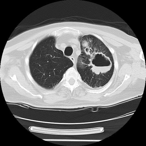 Cavitating pulmonary metastases (Radiopaedia 89545-106544 Axial lung window 12).jpg