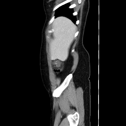 Cecal adenocarcinoma (Radiopaedia 75909-87331 C 14).jpg