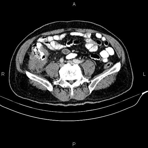 Cecal cancer with appendiceal mucocele (Radiopaedia 91080-108651 B 71).jpg