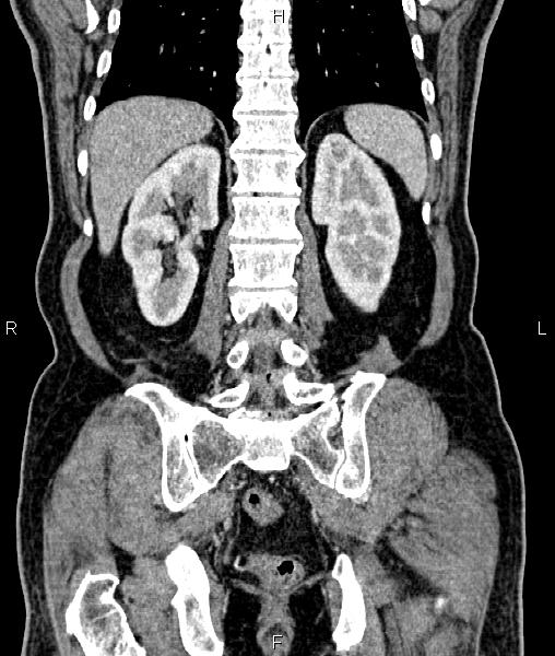 File:Cecal cancer with appendiceal mucocele (Radiopaedia 91080-108651 D 55).jpg