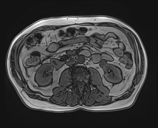 Cecal mass causing appendicitis (Radiopaedia 59207-66532 D 67).jpg