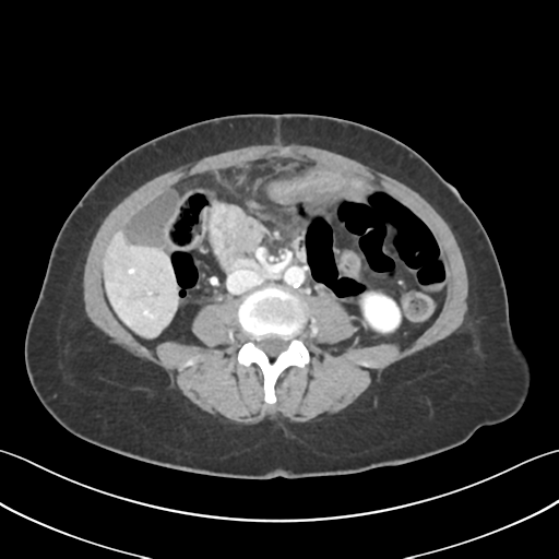 Cecum hernia through the foramen of Winslow (Radiopaedia 46634-51112 A 38).png