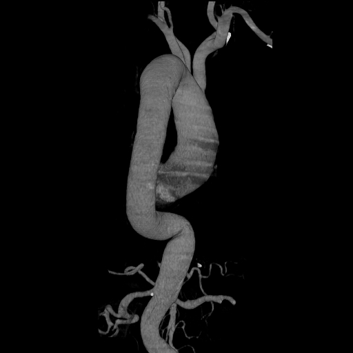 File:Celiac artery aneurysm (Radiopaedia 21574-21525 C 10).JPEG