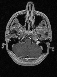 Central neurocytoma (Radiopaedia 56690-63469 Axial T1 C+ 33).jpg