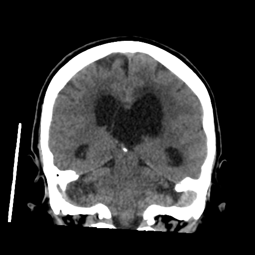Central neurocytoma (Radiopaedia 65317-74346 Coronal non-contrast 37).png
