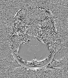 File:Central neurocytoma (Radiopaedia 84497-99872 Axial 12).jpg