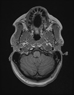 File:Central neurocytoma (Radiopaedia 84497-99872 Axial T1 37).jpg