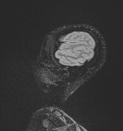 File:Central neurocytoma (Radiopaedia 84497-99872 Sagittal Flair + Gd 135).jpg