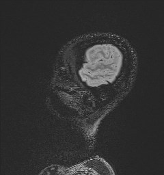 File:Central neurocytoma (Radiopaedia 84497-99872 Sagittal Flair + Gd 22).jpg
