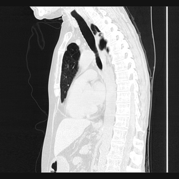 Centrilobular pulmonary emphysema (Radiopaedia 24495-24789 Sagittal lung window 43).jpg