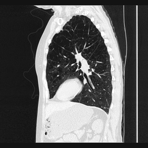 Centrilobular pulmonary emphysema (Radiopaedia 24495-24789 Sagittal lung window 55).jpg