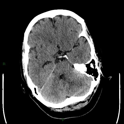Cerebellar abscess (Radiopaedia 78135-90671 Axial non-contrast 36).jpg
