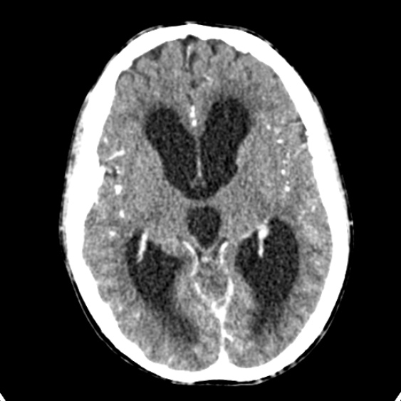Cerebellar abscess secondary to mastoiditis (Radiopaedia 26284-26412 Axial C+ delayed 75).jpg