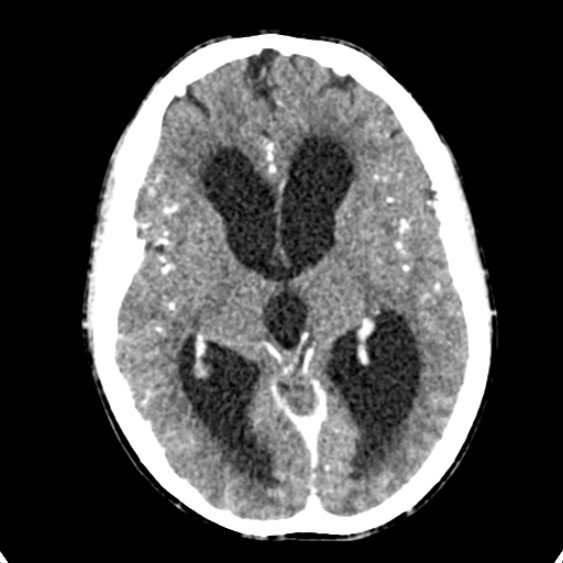 Cerebellar abscess secondary to mastoiditis (Radiopaedia 26284-26412 Axial C+ delayed 77).jpg
