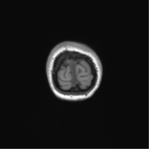 Cerebellar agenesis with hypoplastic pons (pontocerebellar hypoplasia) (Radiopaedia 57224-64138 Coronal T1 6).png