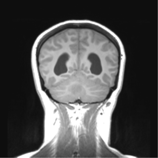 Cerebellar ependymoma complicated by post-operative subdural hematoma (Radiopaedia 83322-97736 Coronal T1 44).png