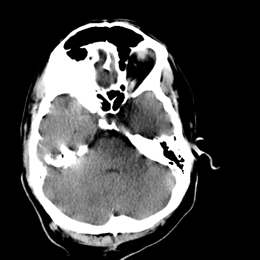 File:Cerebellar infarct due to vertebral artery dissection with posterior fossa decompression (Radiopaedia 82779-97029 Axial non-contrast 7).png