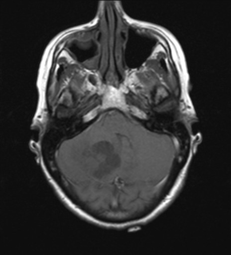 File:Cerebellar metastases (Radiopaedia 24038-24249 Axial T1 13).jpg