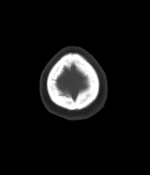 Cerebellar metastases - colorectal adenocarcinoma (Radiopaedia 40947-43652 AX Bone C- 2.0 MPR 64).png