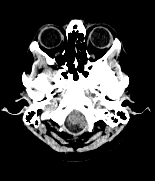 Cerebellar metastases - colorectal adenocarcinoma (Radiopaedia 40947-43652 Axial non-contrast 6).png