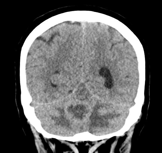 Cerebellar metastasis (Radiopaedia 54578-60812 Coronal non-contrast 45).png