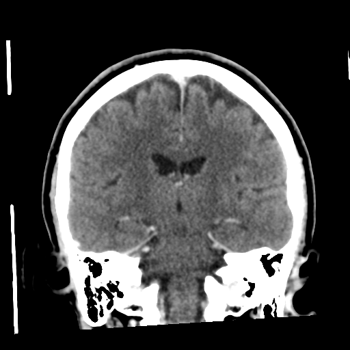 Cerebellar metastasis (cystic appearance) (Radiopaedia 41395-44258 D 36).png
